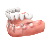 Implanty zębowe Częstochowa