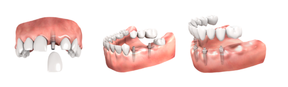 PRZYKŁADY ODBUDOWY ZĘBÓW NA IMPLANTACH