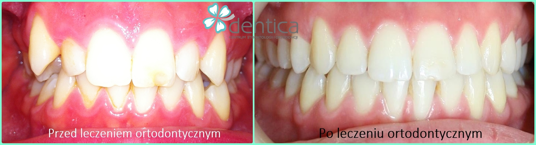 metamorfoza po leczeniu ortodontycznym