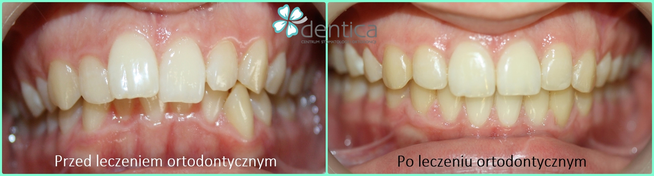 metamorfoza po leczeniu ortodontycznym