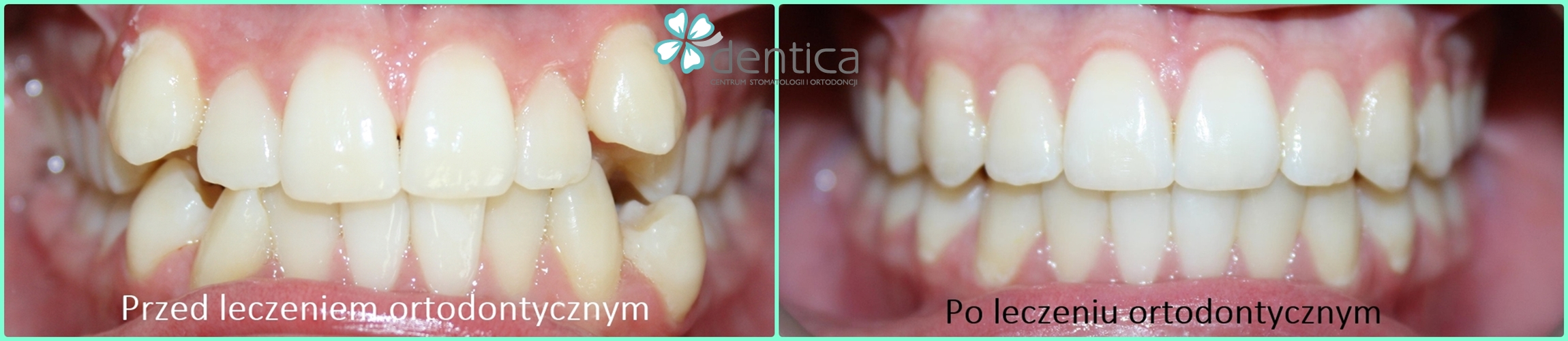 metamorfoza po leczeniu ortodontycznym