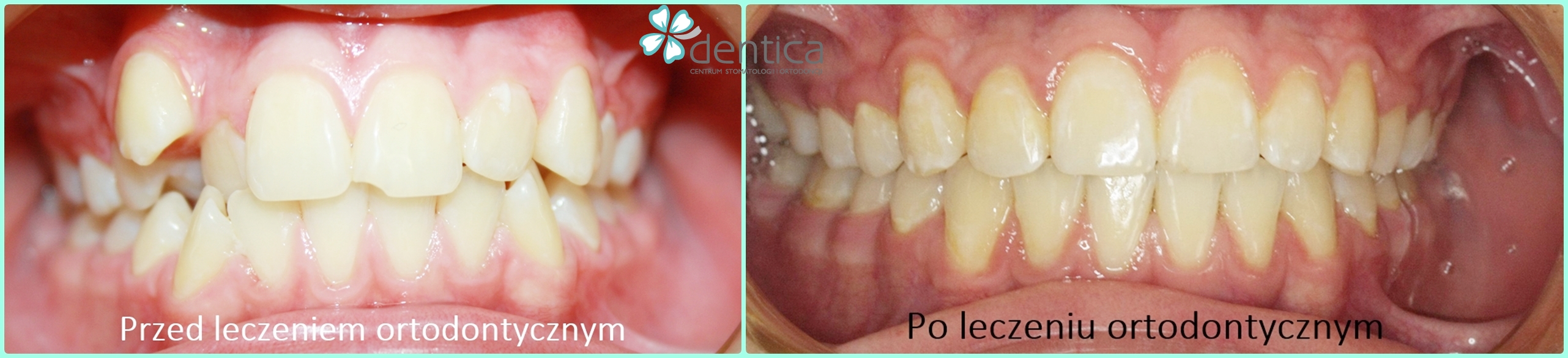 metamorfoza po leczeniu ortodontycznym
