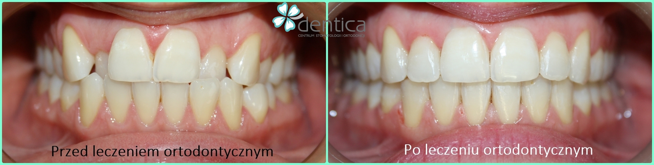 metamorfoza po leczeniu ortodontycznym